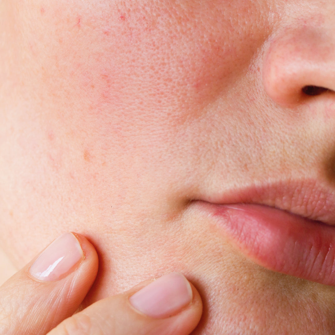 Inno-Derma® Redness Cream 50ml